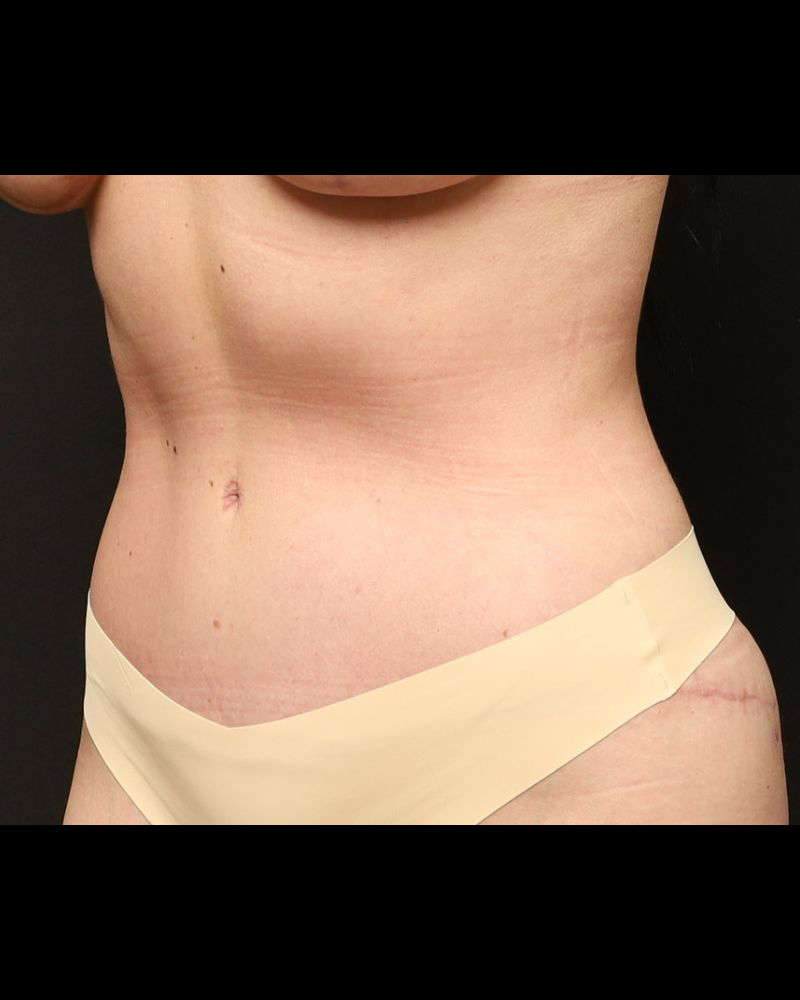 Tummy Tuck Before and After 17