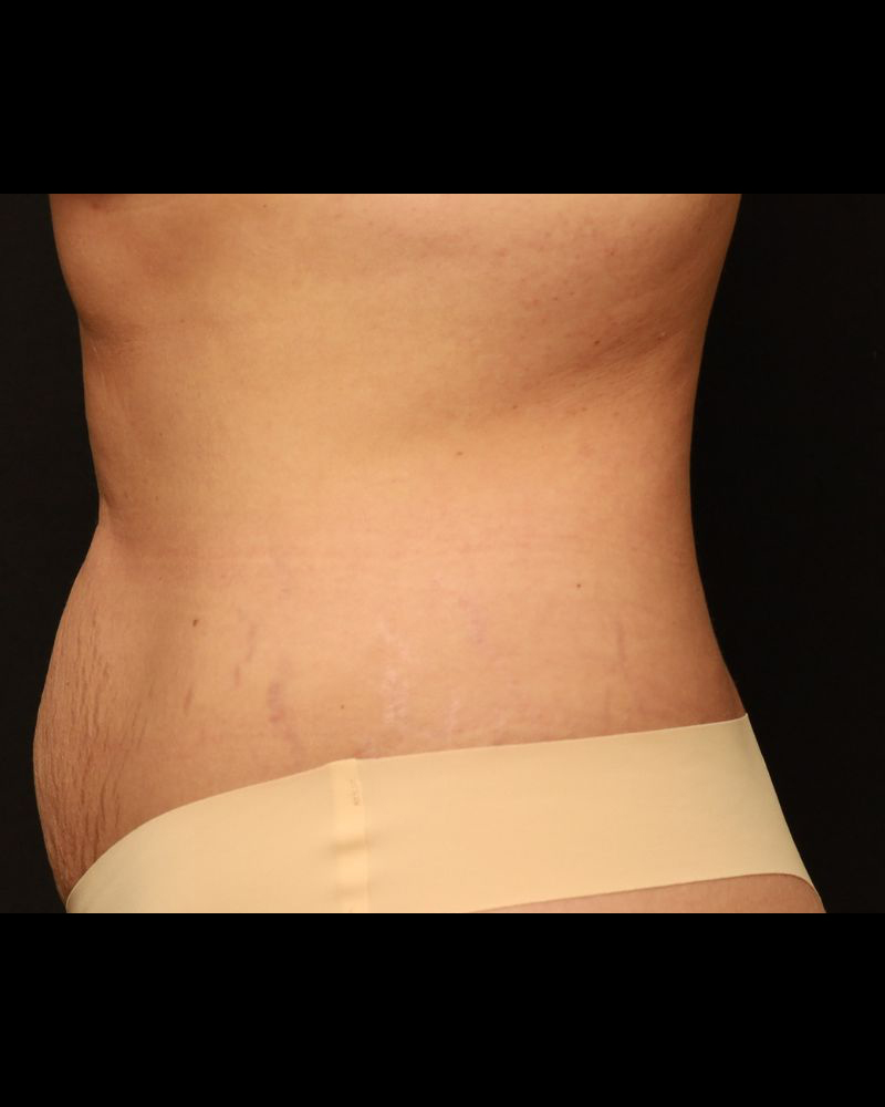 Tummy Tuck Before and After 17