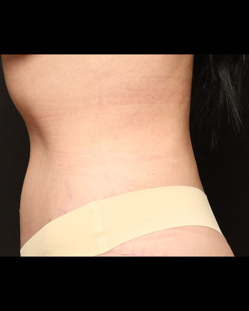 Tummy Tuck Before and After 17