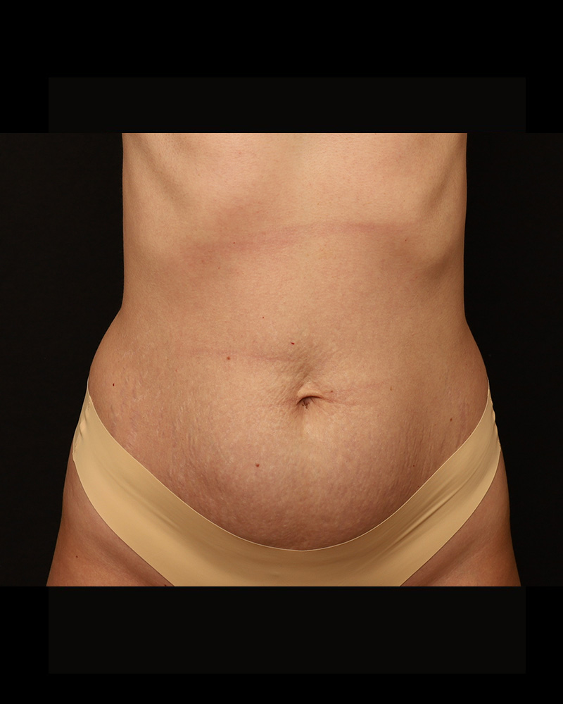 Tummy Tuck Before and After 18