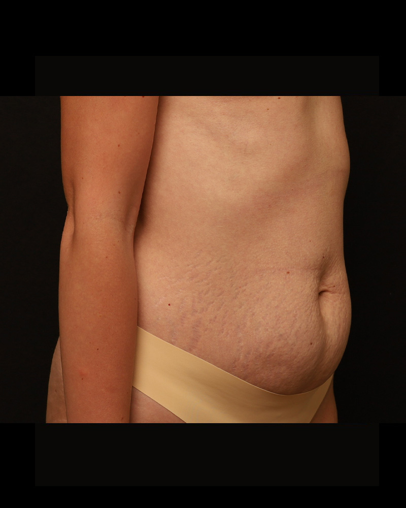 Tummy Tuck Before and After 18