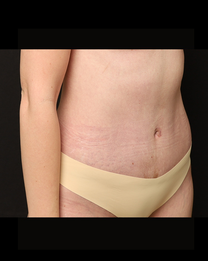 Tummy Tuck Before and After 18