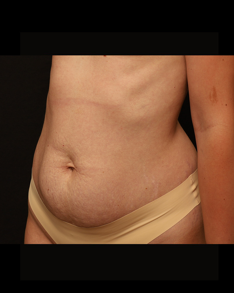 Tummy Tuck Before and After 18