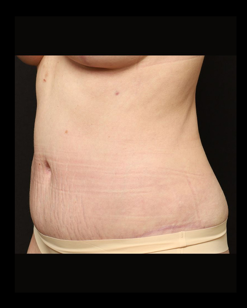 Tummy Tuck Before and After 18