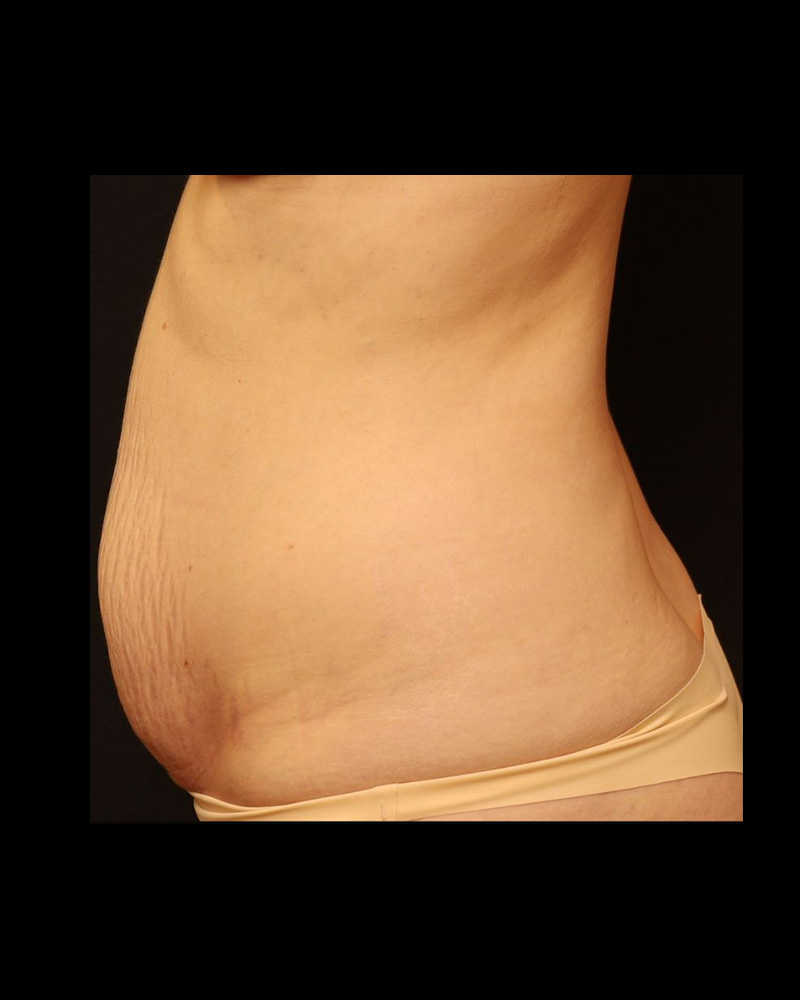 Tummy Tuck Before and After 18