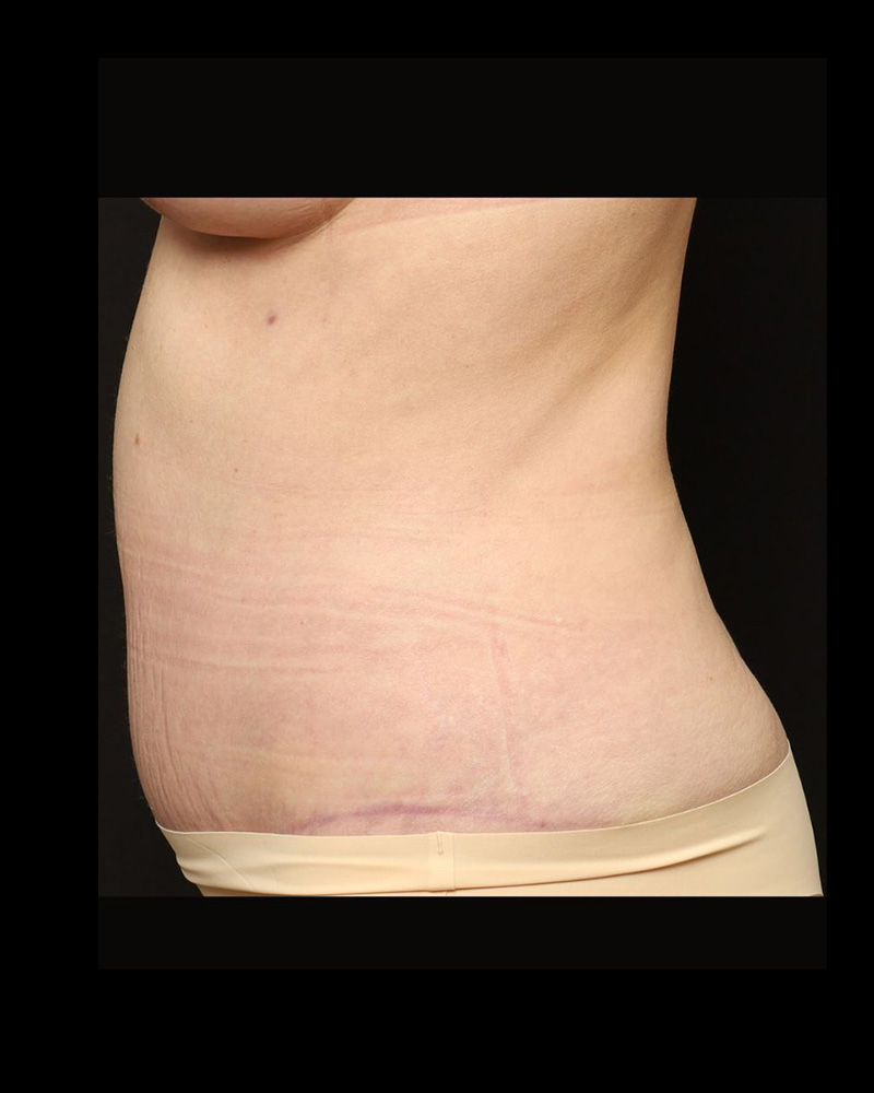 Tummy Tuck Before and After 18