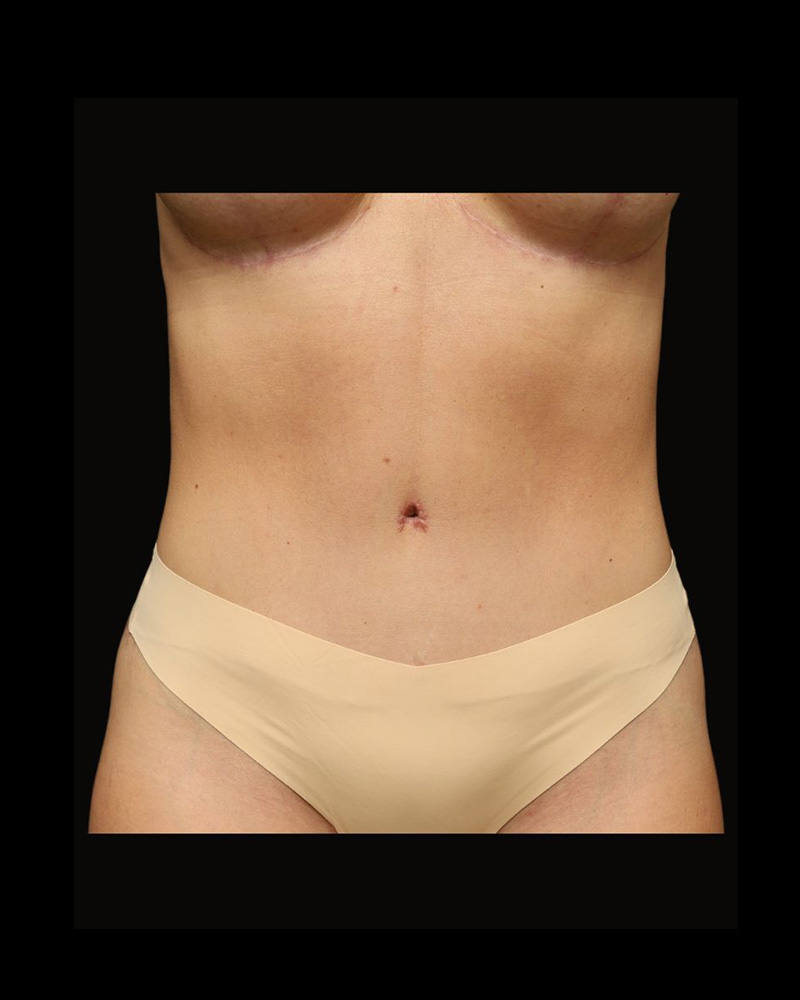 Tummy Tuck Before and After 07