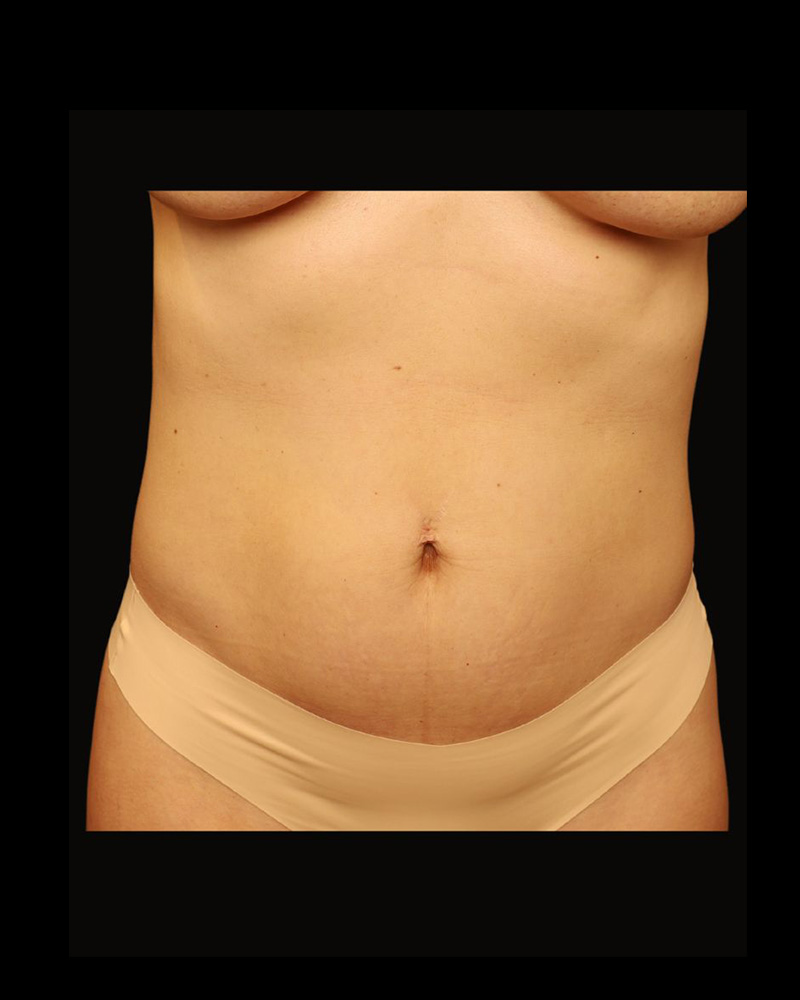 Tummy Tuck Before and After 20