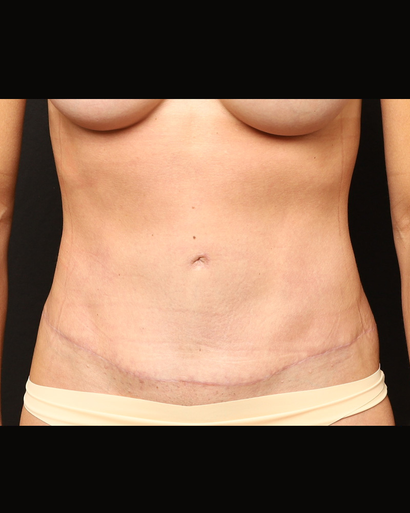 Tummy Tuck Before and After 07