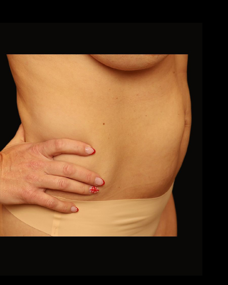 Tummy Tuck Before and After 20