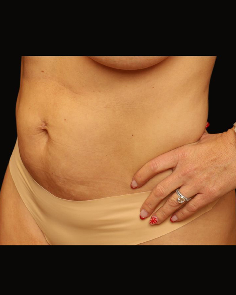 Tummy Tuck Before and After 20