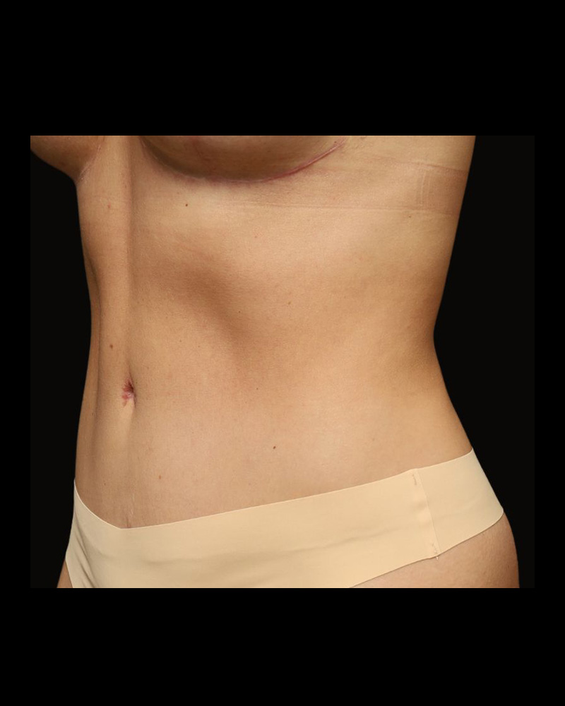 Tummy Tuck Before and After 20