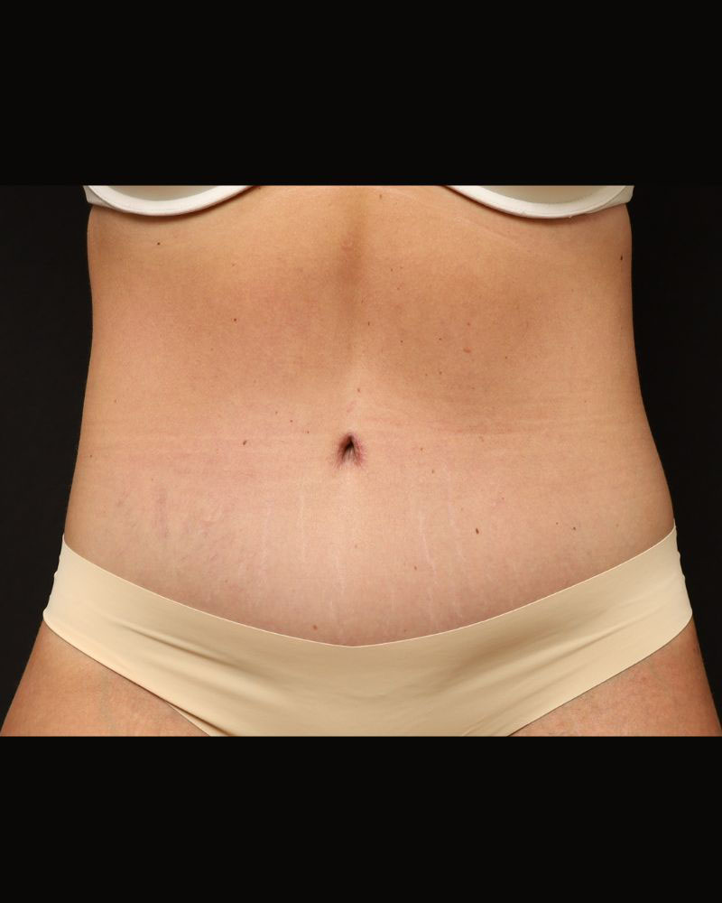 Tummy Tuck Before and After 07