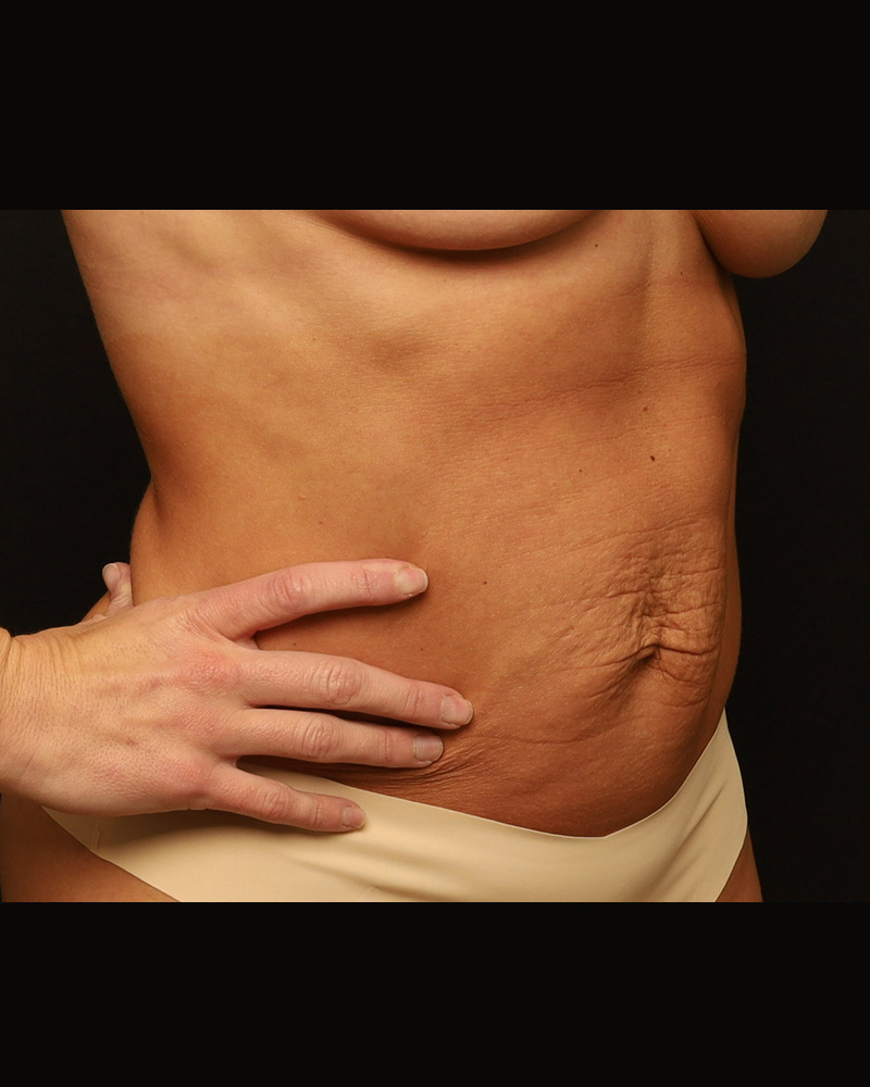 Tummy Tuck Before and After 21