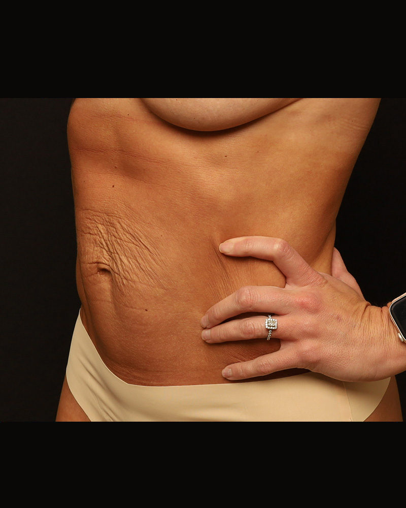 Tummy Tuck Before and After 21