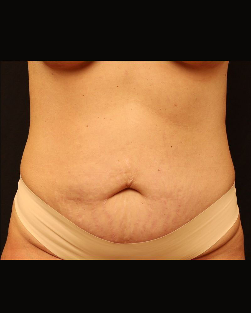 Tummy Tuck Before and After 22