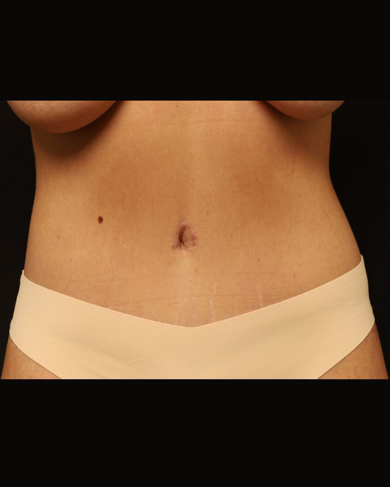 Tummy Tuck Before and After 07