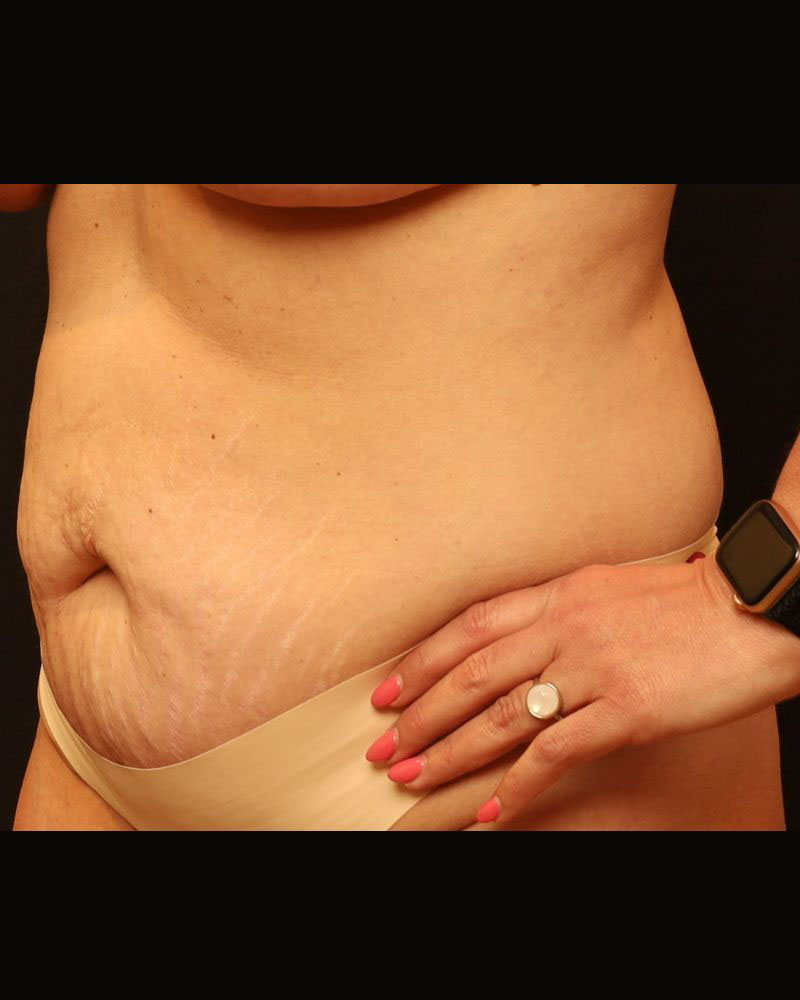 Tummy Tuck Before and After 22