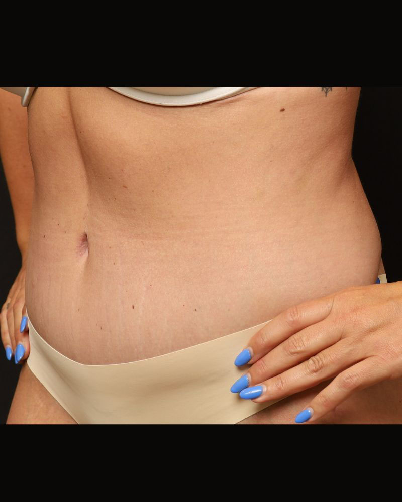 Tummy Tuck Before and After 22