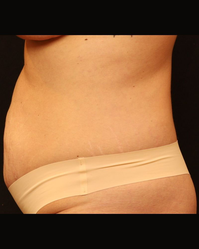 Tummy Tuck Before and After 22