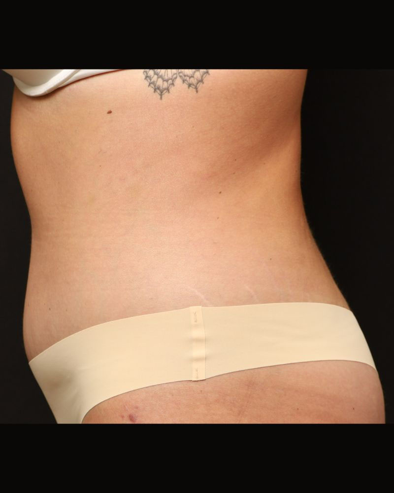 Tummy Tuck Before and After 22