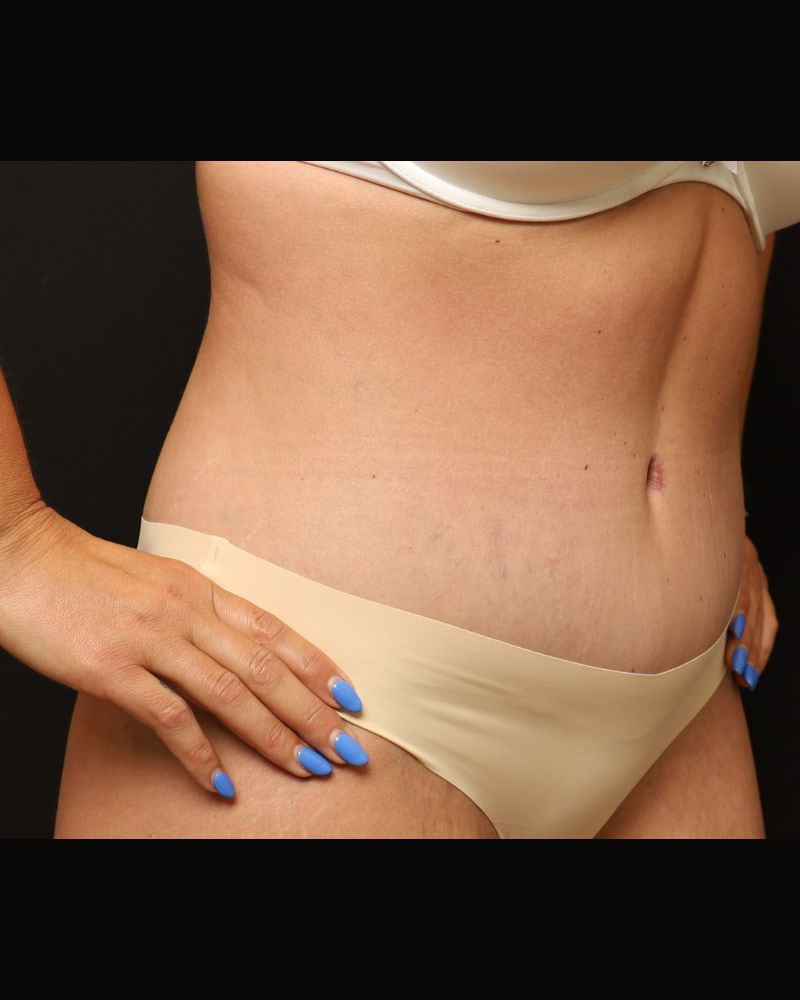 Tummy Tuck Before and After 22