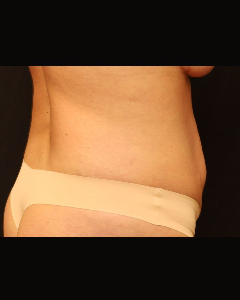 Tummy Tuck Before and After 22