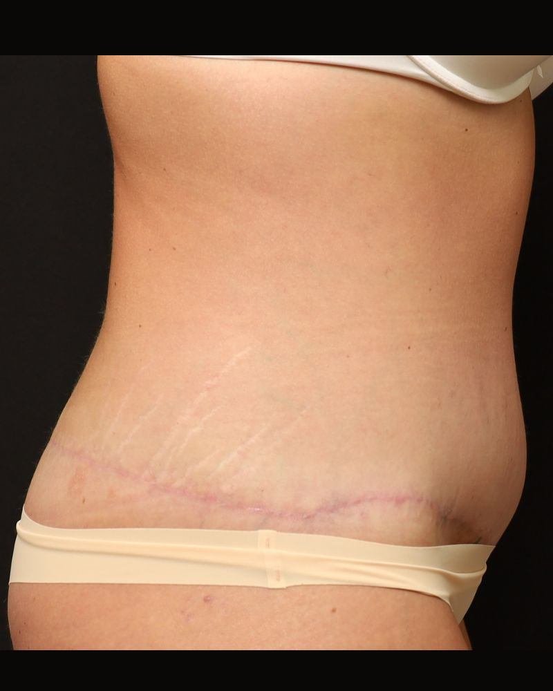 Tummy Tuck Before and After 22