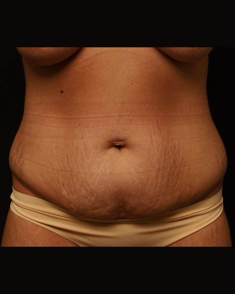 Tummy Tuck Before and After 23