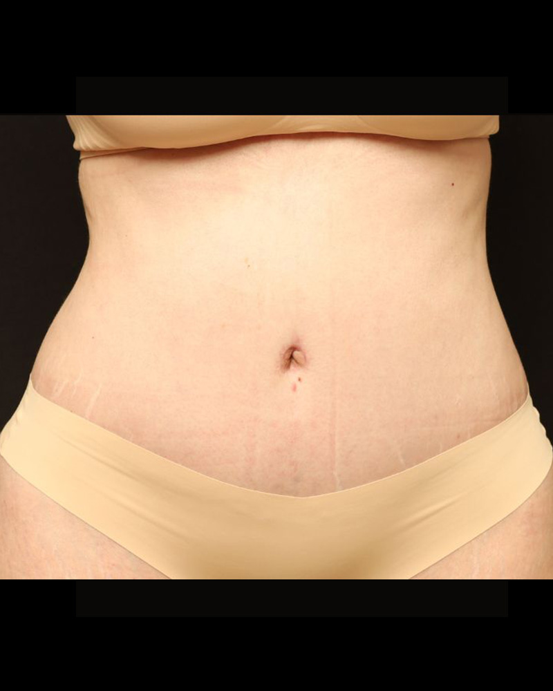 Tummy Tuck Before and After 07