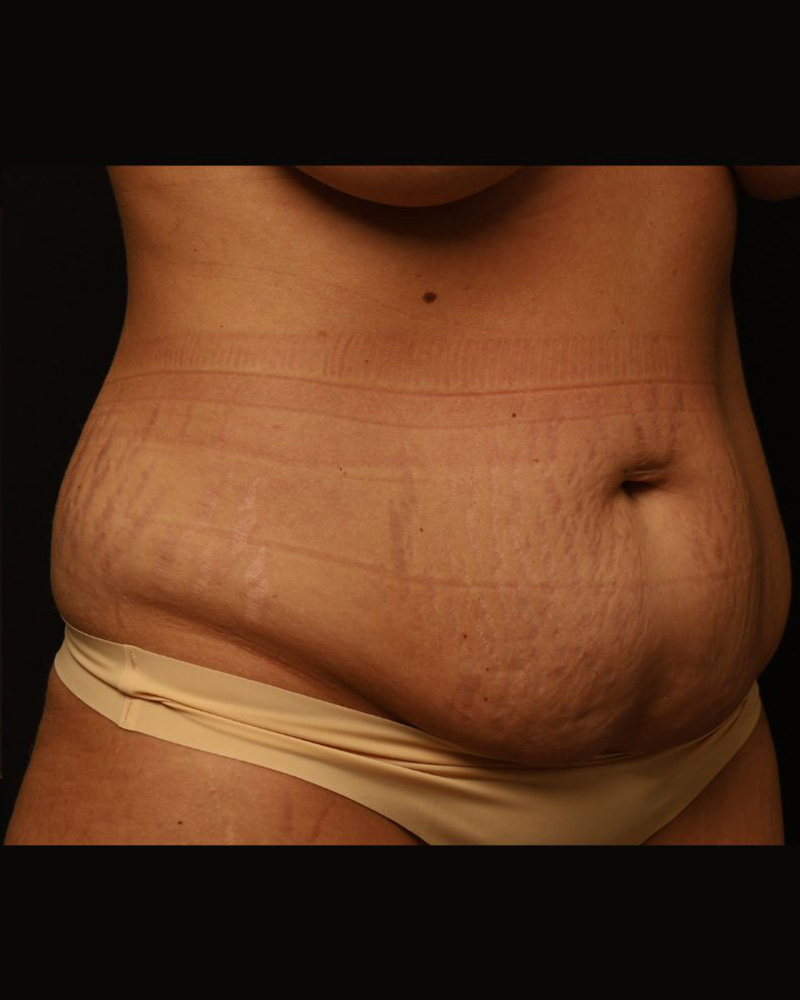 Tummy Tuck Before and After 23