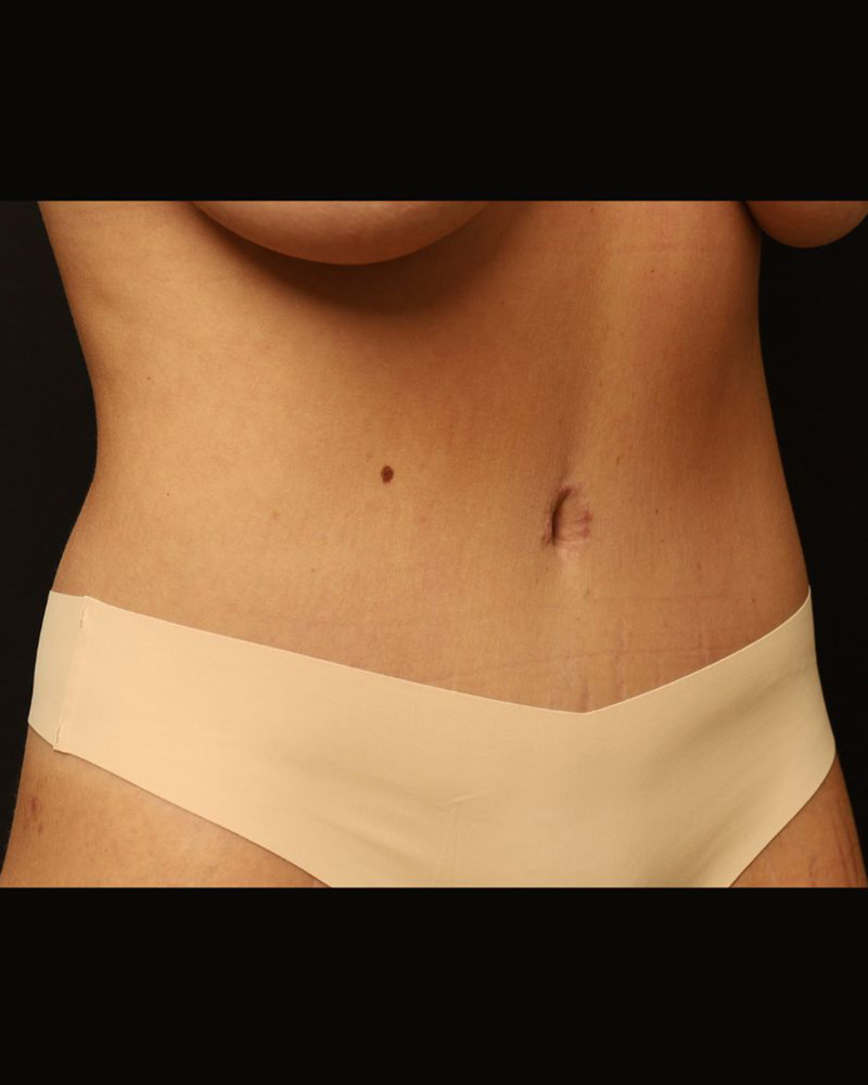 Tummy Tuck Before and After 23