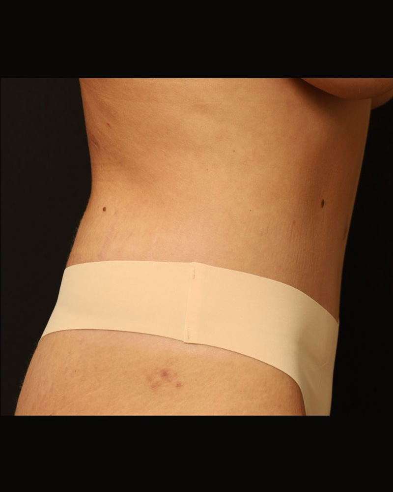 Tummy Tuck Before and After 23