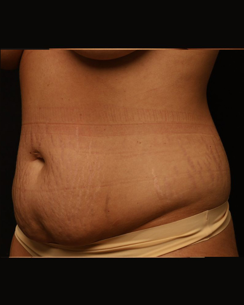 Tummy Tuck Before and After 23