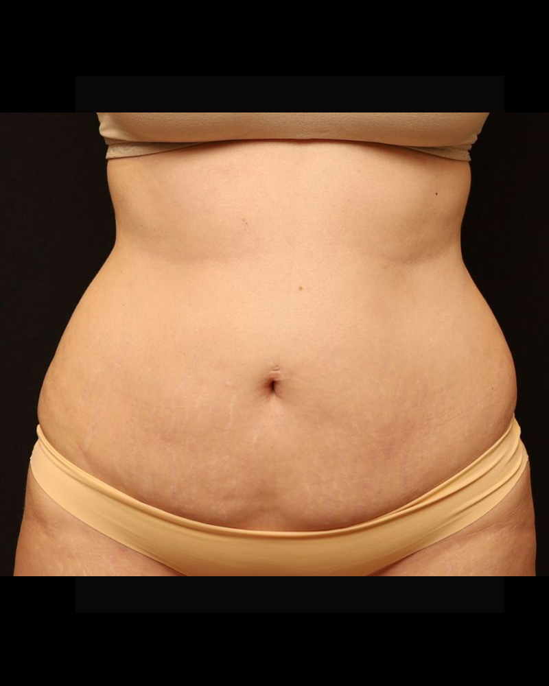 Tummy Tuck Before and After 24