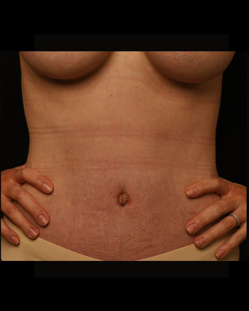 Tummy Tuck Before and After 07