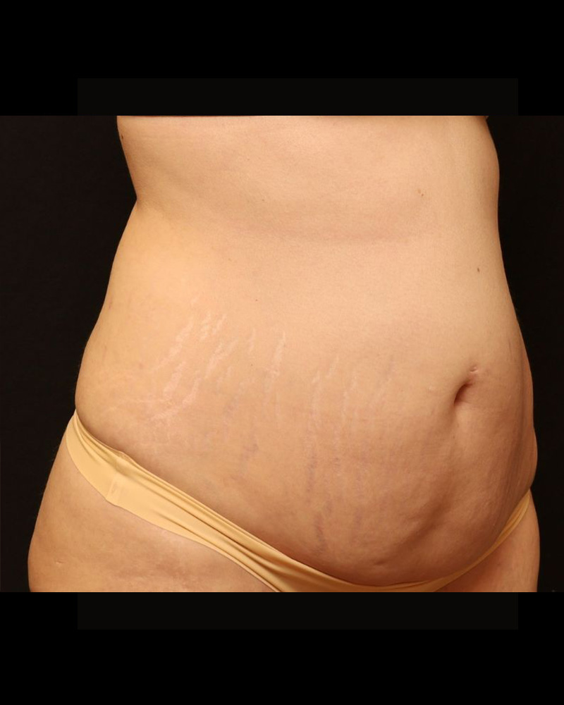 Tummy Tuck Before and After 24