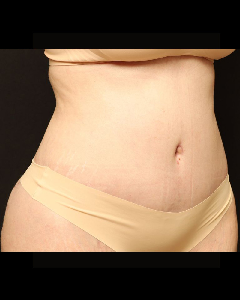Tummy Tuck Before and After 24