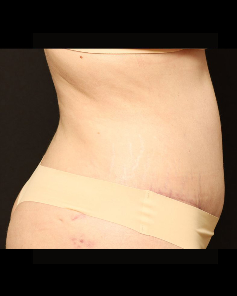 Tummy Tuck Before and After 24
