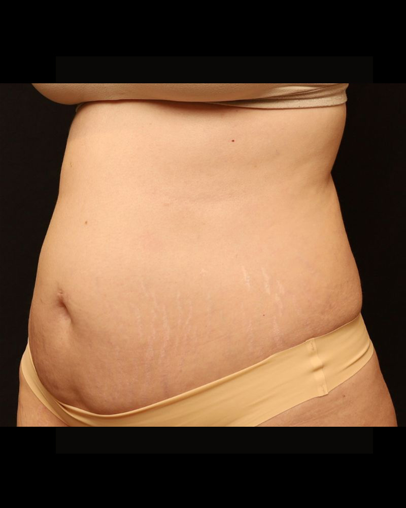 Tummy Tuck Before and After 24