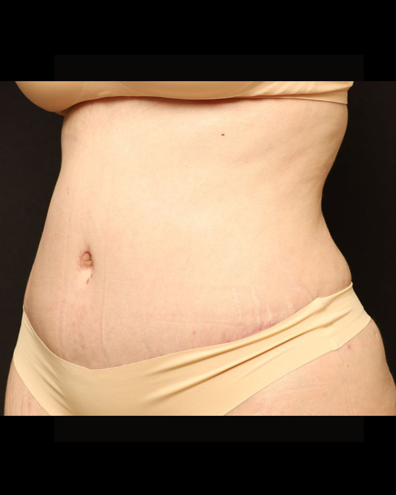 Tummy Tuck Before and After 24