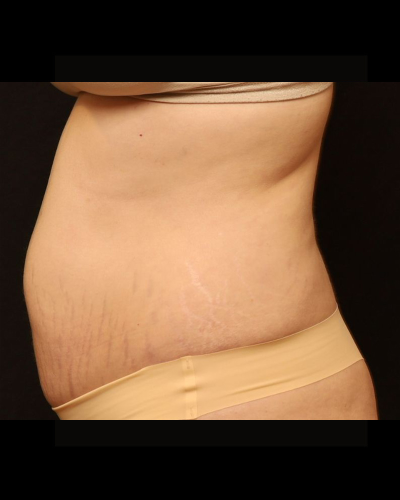 Tummy Tuck Before and After 24