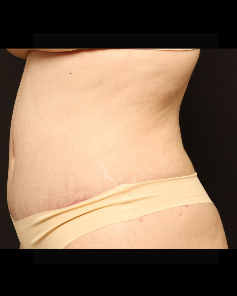 Tummy Tuck Before and After 24