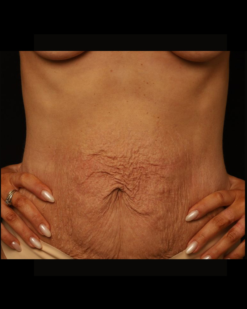 Tummy Tuck Before and After 25