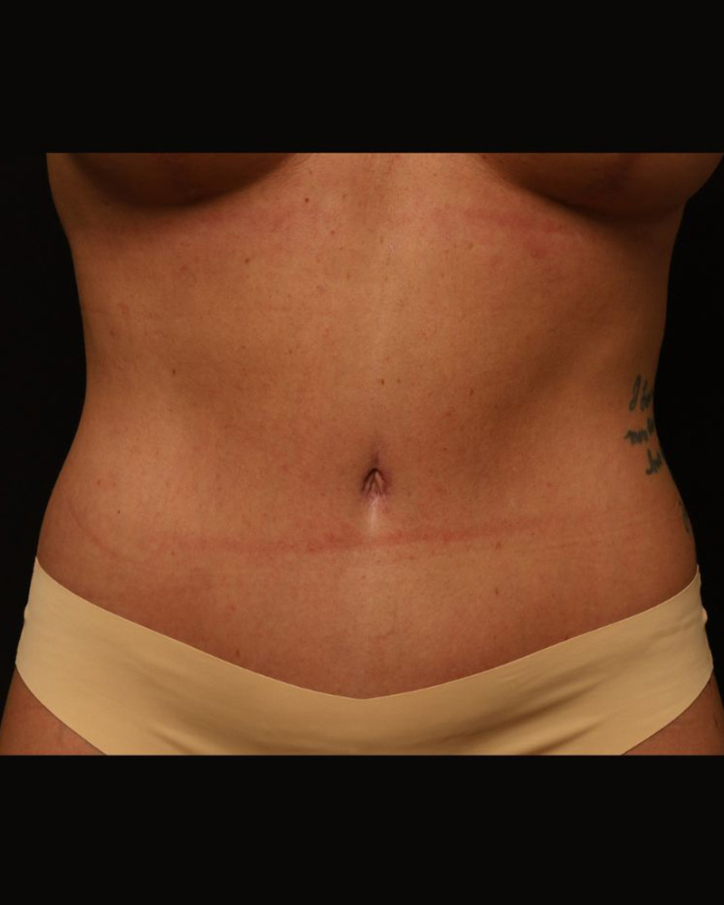 Tummy Tuck Before and After 07