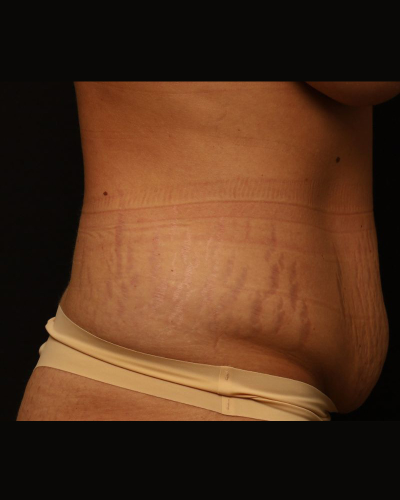Tummy Tuck Before and After 25