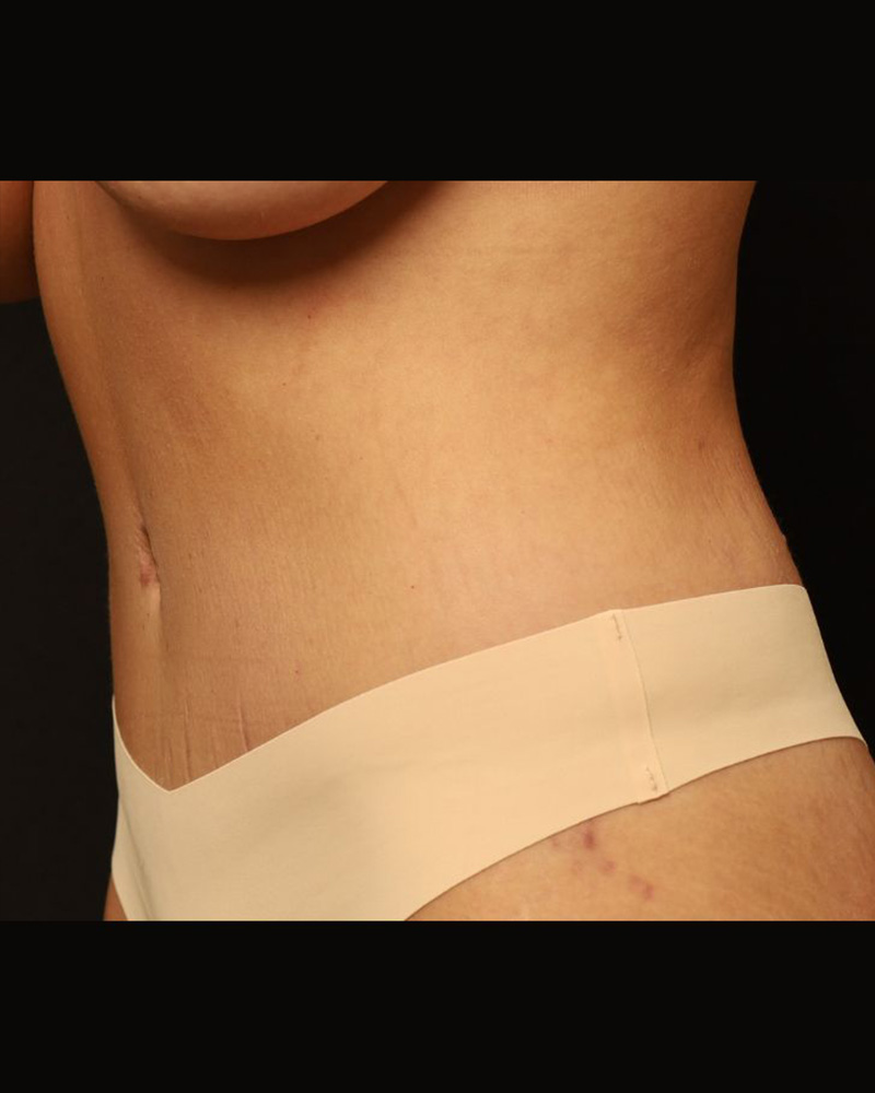 Tummy Tuck Before and After 25