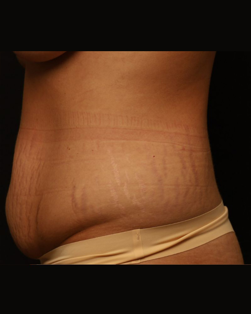 Tummy Tuck Before and After 25