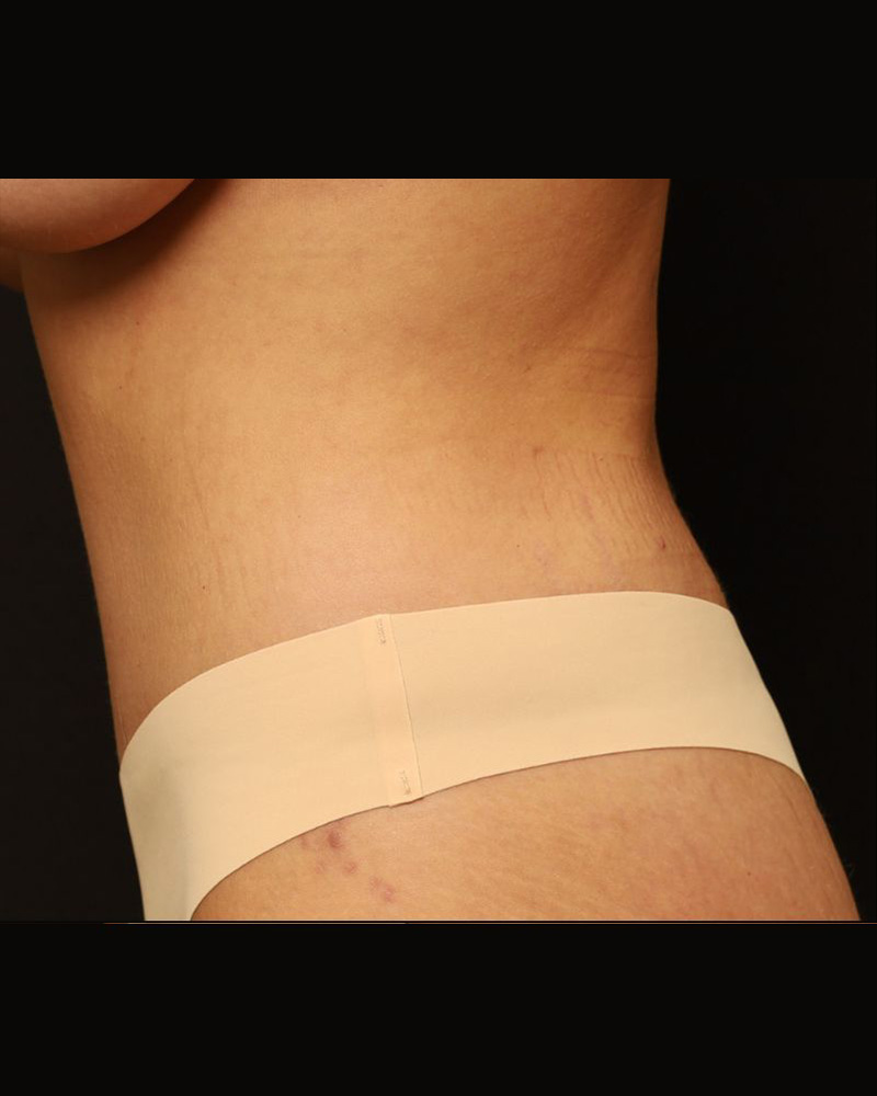 Tummy Tuck Before and After 25