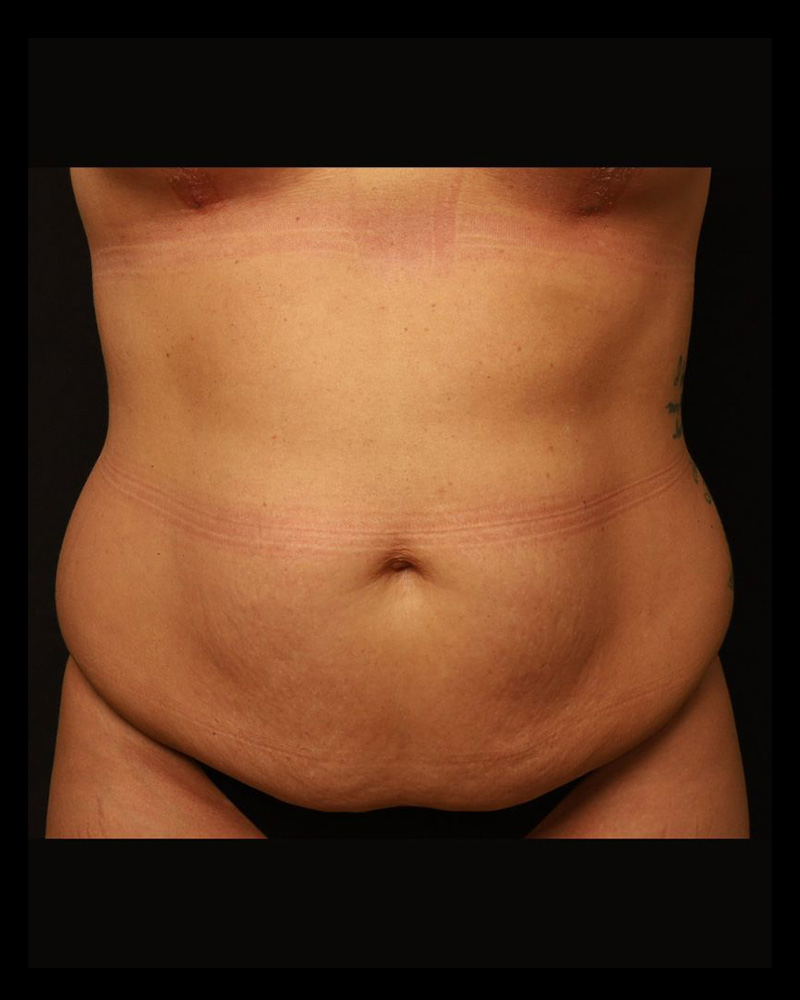 Tummy Tuck Before and After 26